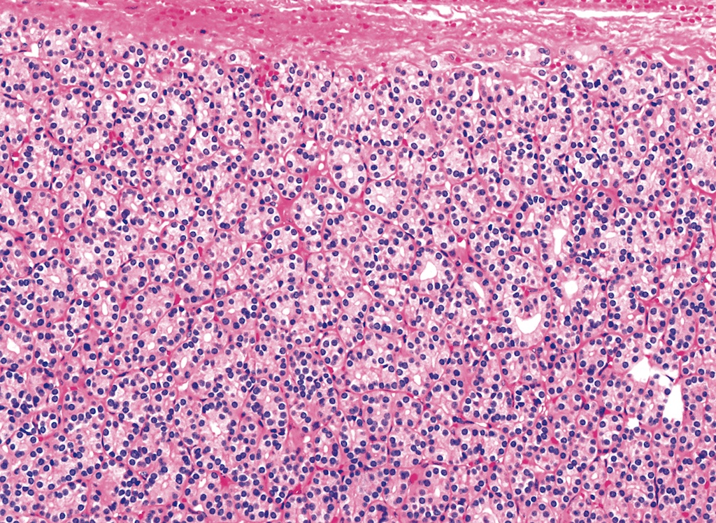 Pathology Outlines Follicular Adenoma